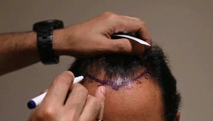 Haartransplantation klinik für Frauen: Eine Option bei Haarausfall
